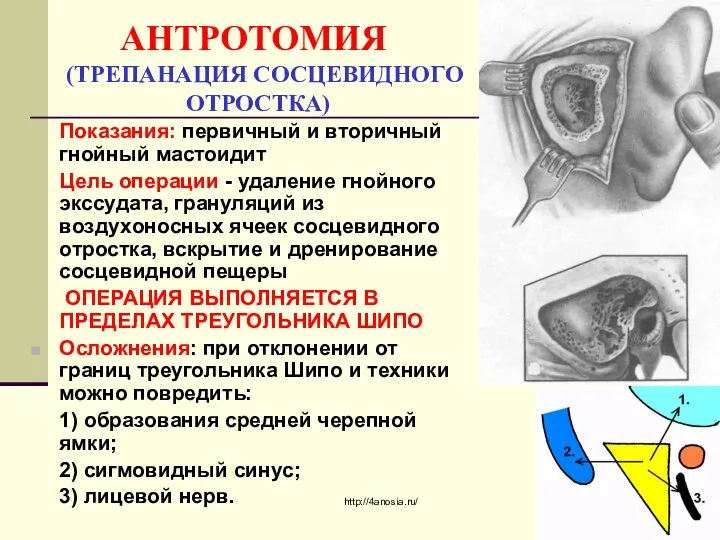 АНТРОТОМИЯ (ТРЕПАНАЦИЯ СОСЦЕВИДНОГО ОТРОСТКА) Показания: первичный и вторичный гнойный мастоидит