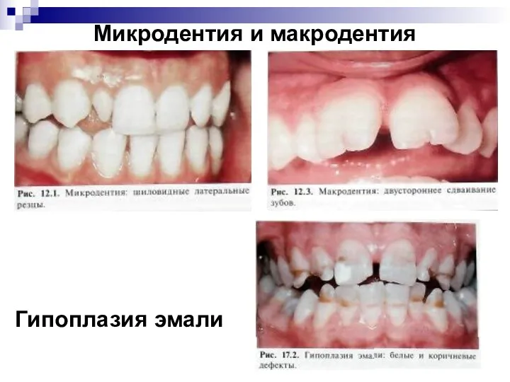 Микродентия и макродентия Гипоплазия эмали