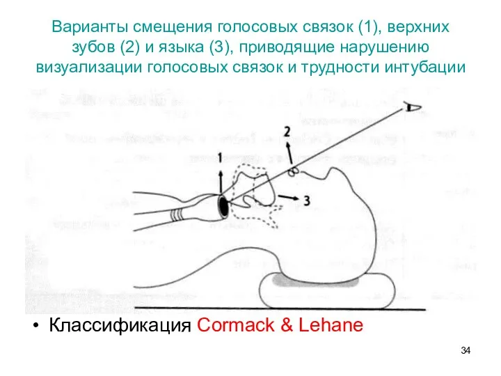 Варианты смещения голосовых связок (1), верхних зубов (2) и языка