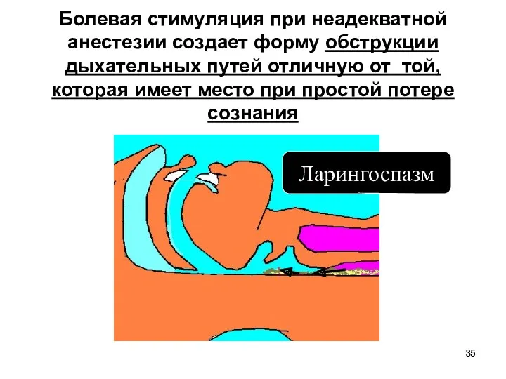 Ларингоспазм Болевая стимуляция при неадекватной анестезии создает форму обструкции дыхательных