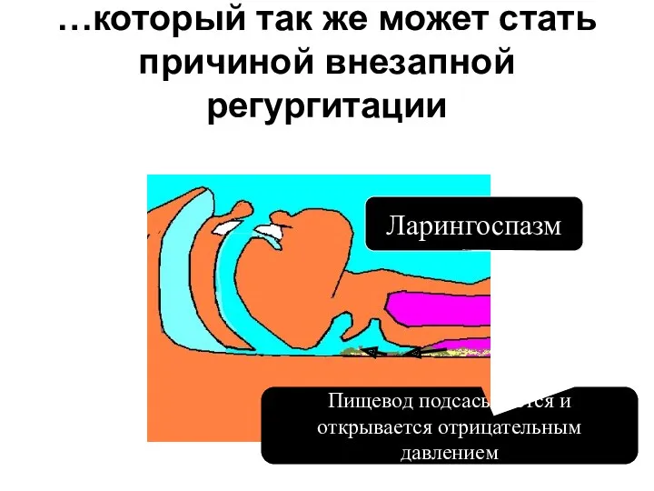 Ларингоспазм Пищевод подсасывается и открывается отрицательным давлением …который так же может стать причиной внезапной регургитации