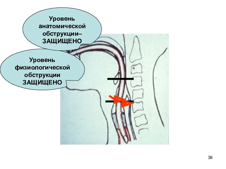 Уровень физиологической обструкции ЗАЩИЩЕНО Уровень анатомической обструкции– ЗАЩИЩЕНО