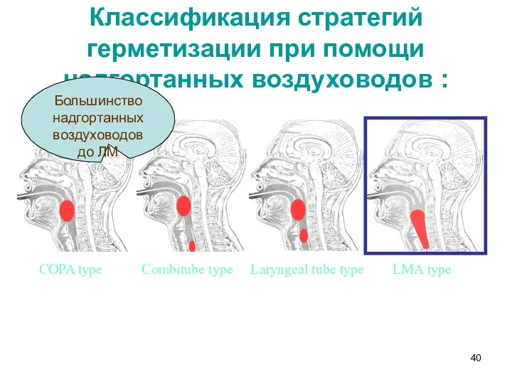 Классификация стратегий герметизации при помощи надгортанных воздуховодов : COPA type