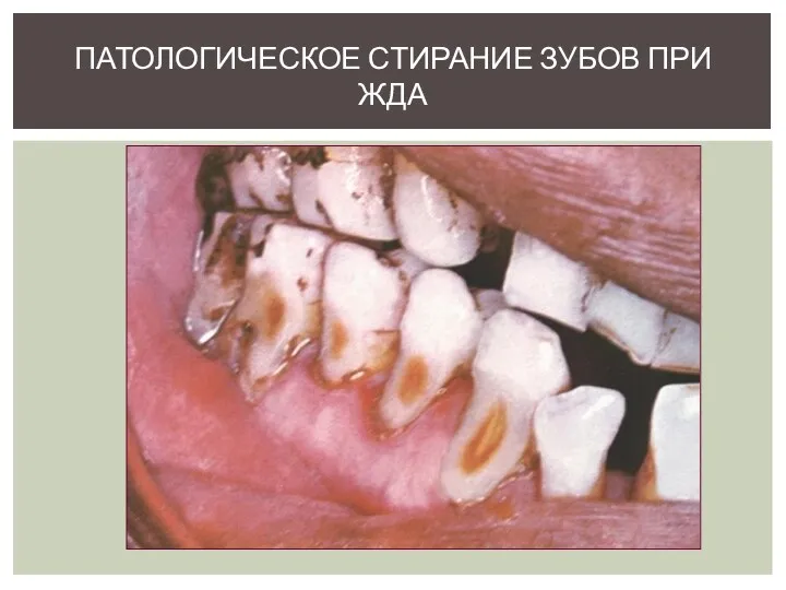 ПАТОЛОГИЧЕСКОЕ СТИРАНИЕ ЗУБОВ ПРИ ЖДА