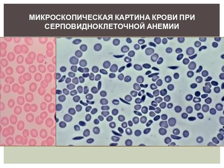 МИКРОСКОПИЧЕСКАЯ КАРТИНА КРОВИ ПРИ СЕРПОВИДНОКЛЕТОЧНОЙ АНЕМИИ