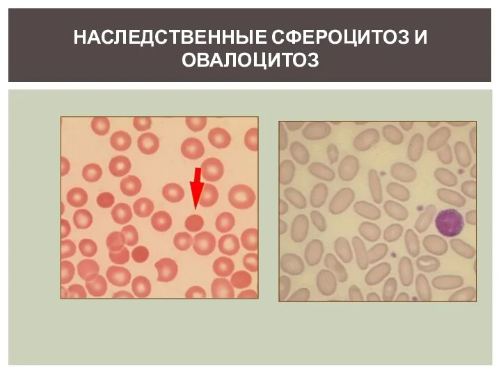 НАСЛЕДСТВЕННЫЕ СФЕРОЦИТОЗ И ОВАЛОЦИТОЗ