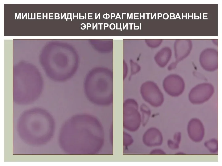 МИШЕНЕВИДНЫЕ И ФРАГМЕНТИРОВАННЫЕ ЭРИТРОЦИТЫ