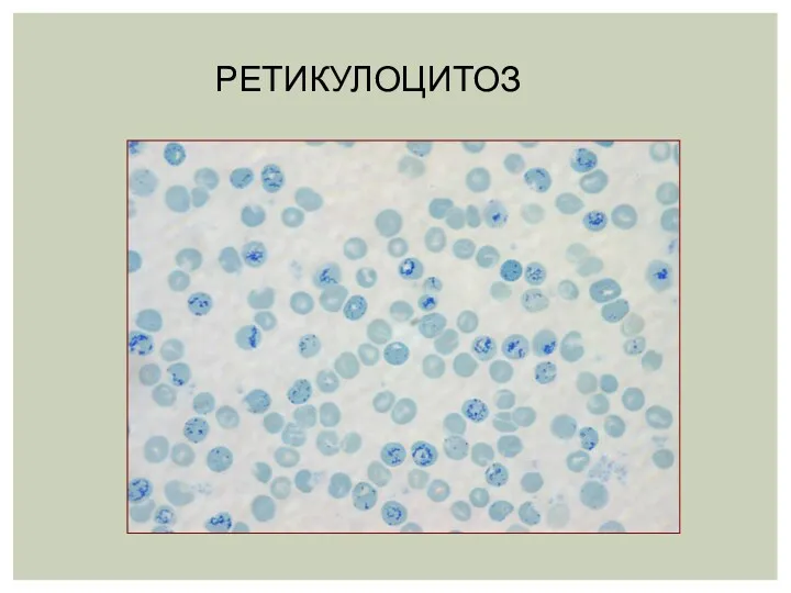 РЕТИКУЛОЦИТОЗ