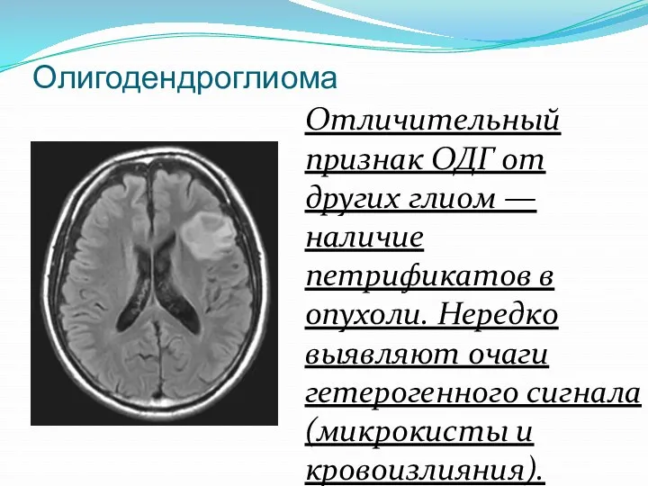 Олигодендроглиома Отличительный признак ОДГ от других глиом — наличие петрификатов