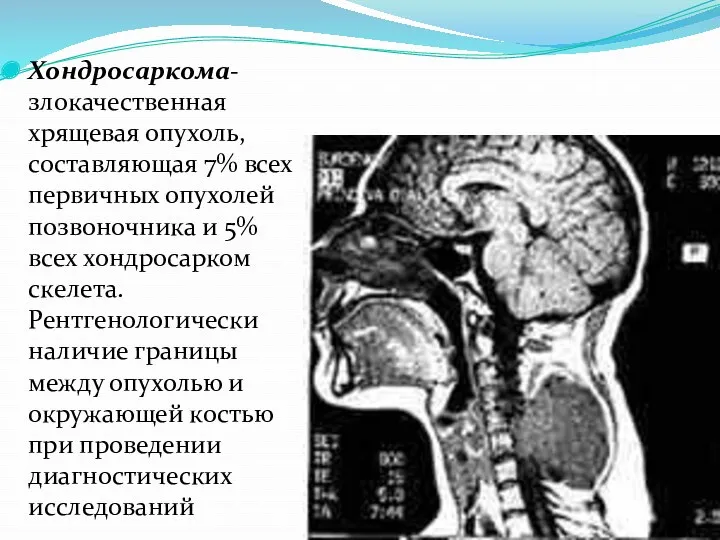 Хондросаркома- злокачественная хрящевая опухоль, составляющая 7% всех первичных опухолей позвоночника