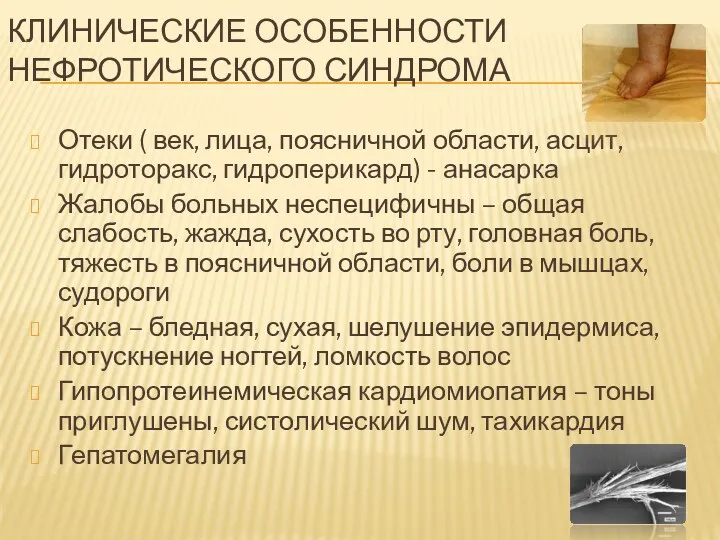 КЛИНИЧЕСКИЕ ОСОБЕННОСТИ НЕФРОТИЧЕСКОГО СИНДРОМА Отеки ( век, лица, поясничной области,