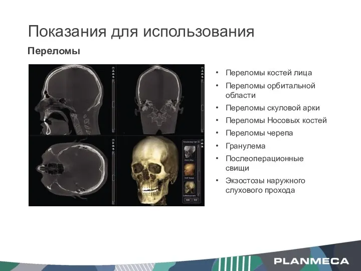 Переломы Показания для использования Переломы костей лица Переломы орбитальной области Переломы скуловой арки