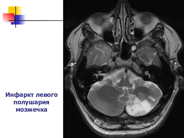 Инфаркт левого полушария мозжечка