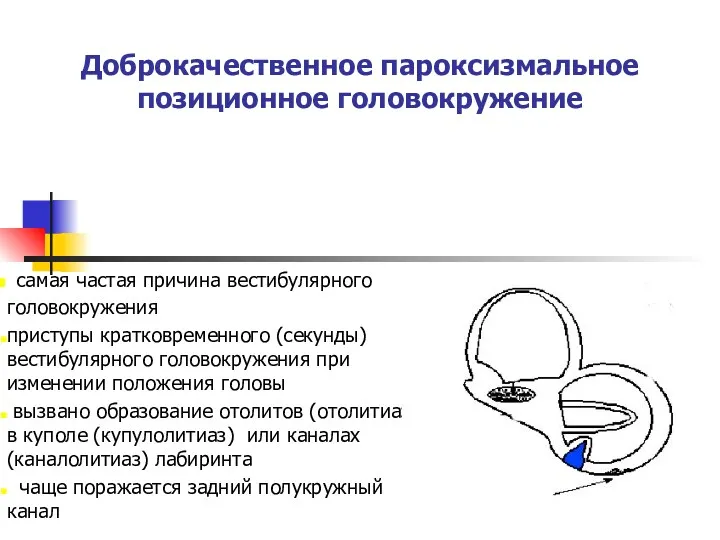 Доброкачественное пароксизмальное позиционное головокружение самая частая причина вестибулярного головокружения приступы