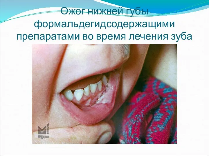 Ожог нижней губы формальдегидсодержащими препаратами во время лечения зуба