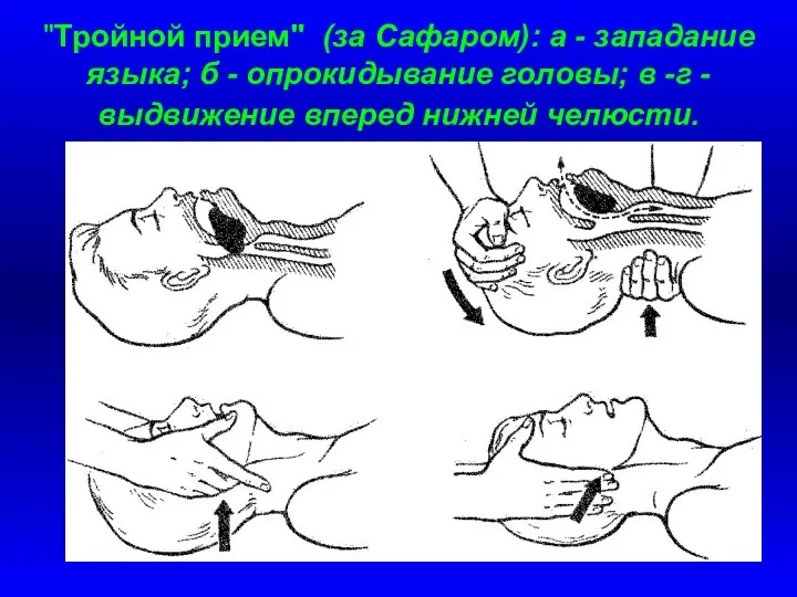 "Тройной прием" (за Сафаром): а - западание языка; б -