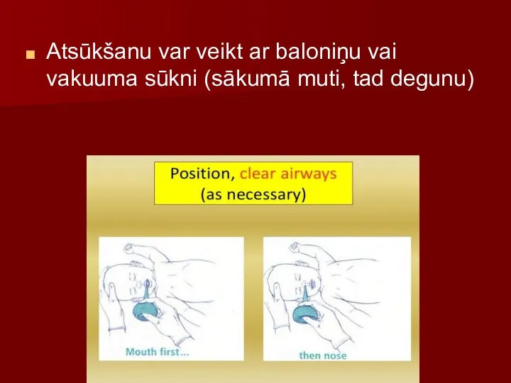 Atsūkšanu var veikt ar baloniņu vai vakuuma sūkni (sākumā muti, tad degunu)