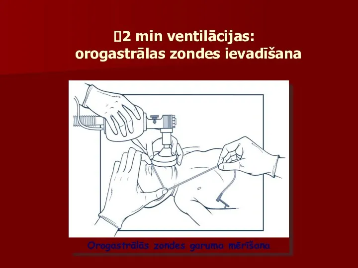 2 min ventilācijas: orogastrālas zondes ievadīšana Orogastrālās zondes garuma mērīšana