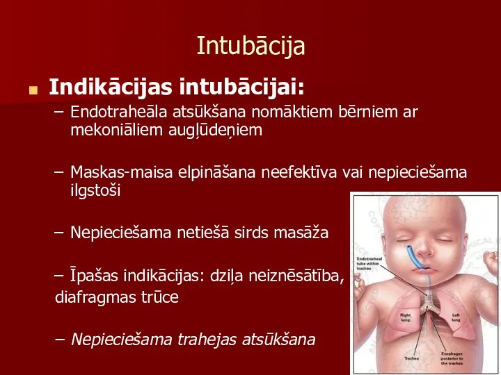 Intubācija Indikācijas intubācijai: Endotraheāla atsūkšana nomāktiem bērniem ar mekoniāliem augļūdeņiem