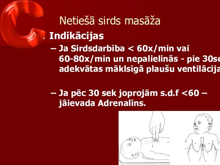 Netiešā sirds masāža Indikācijas Ja Sirdsdarbība Ja pēc 30 sek joprojām s.d.f