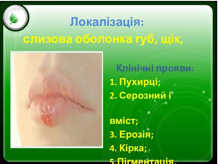 Локалізація: слизова оболонка губ, щік, носа. Клінічні прояви: 1. Пухирці;