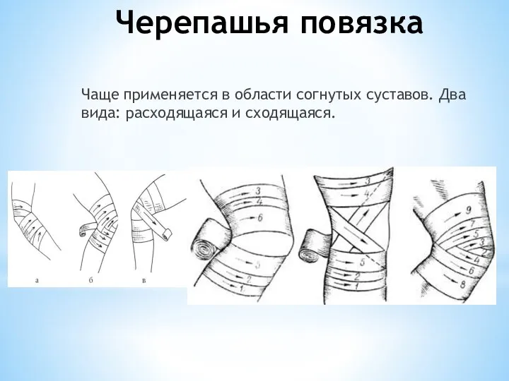 Черепашья повязка Чаще применяется в области согнутых суставов. Два вида: расходящаяся и сходящаяся.