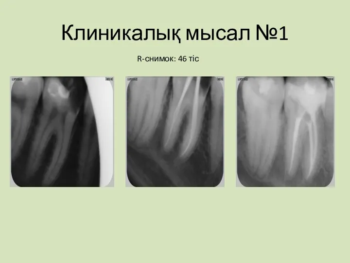 Клиникалық мысал №1 R-снимок: 46 тіс