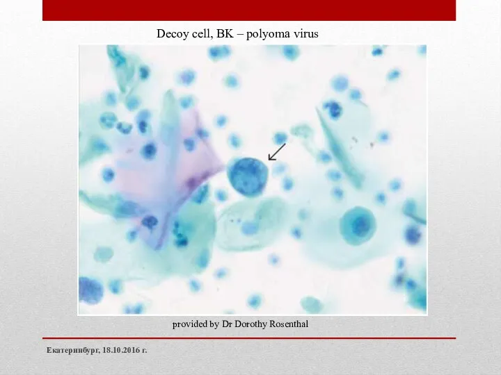 Екатеринбург, 18.10.2016 г. Decoy cell, BK – polyoma virus provided by Dr Dorothy Rosenthal