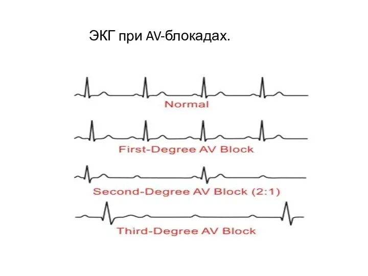 ЭКГ при AV-блокадах.