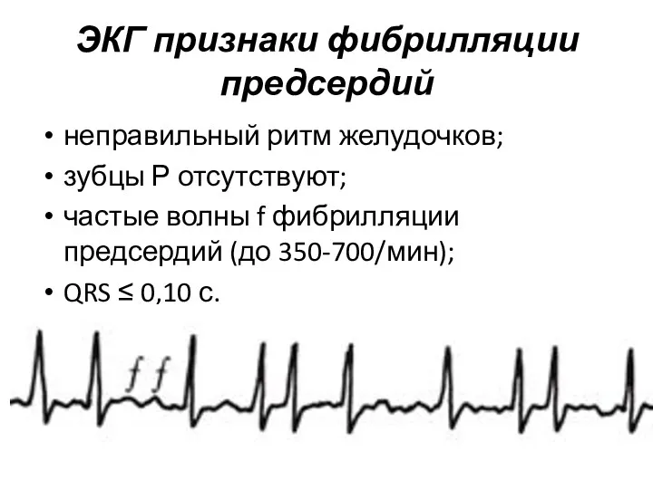 ЭКГ признаки фибрилляции предсердий неправильный ритм желудочков; зубцы Р отсутствуют; частые волны f