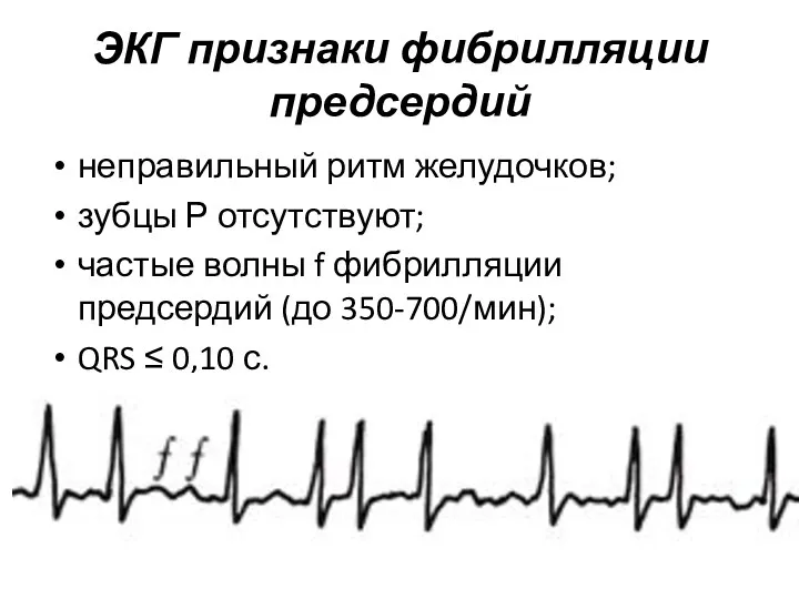 ЭКГ признаки фибрилляции предсердий неправильный ритм желудочков; зубцы Р отсутствуют;
