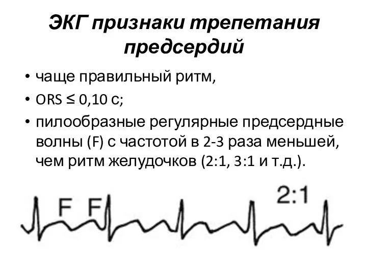 ЭКГ признаки трепетания предсердий чаще правильный ритм, ORS ≤ 0,10 с; пилообразные регулярные