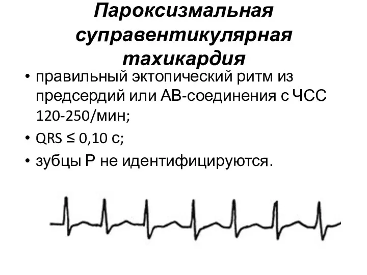 Пароксизмальная суправентикулярная тахикардия правильный эктопический ритм из предсердий или АВ-соединения с ЧСС 120-250/мин;