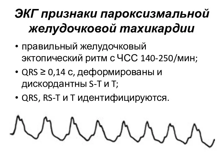 ЭКГ признаки пароксизмальной желудочковой тахикардии правильный желудочковый эктопический ритм с ЧСС 140-250/мин; QRS