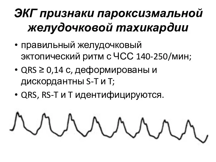 ЭКГ признаки пароксизмальной желудочковой тахикардии правильный желудочковый эктопический ритм с