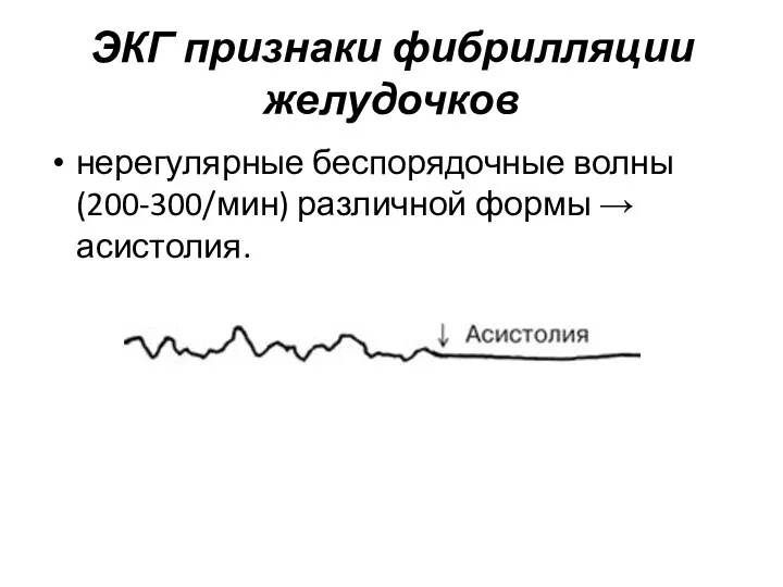 ЭКГ признаки фибрилляции желудочков нерегулярные беспорядочные волны (200-300/мин) различной формы → асистолия.