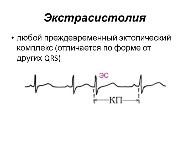 Экстрасистолия любой преждевременный эктопический комплекс (отличается по форме от других QRS)