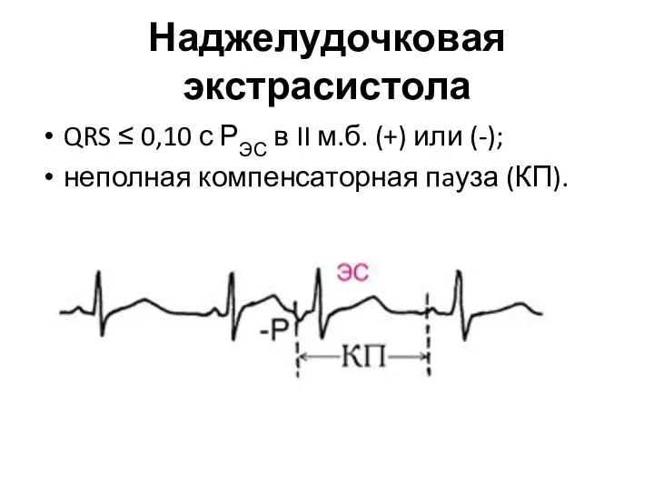 Наджелудочковая экстрасистола QRS ≤ 0,10 с РЭС в II м.б. (+) или (-);
