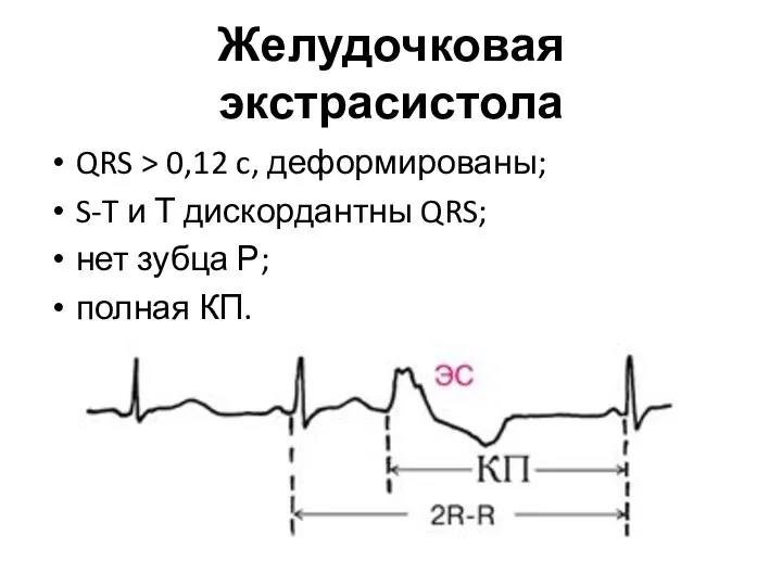Желудочковая экстрасистола QRS > 0,12 c, деформированы; S-T и Т дискордантны QRS; нет