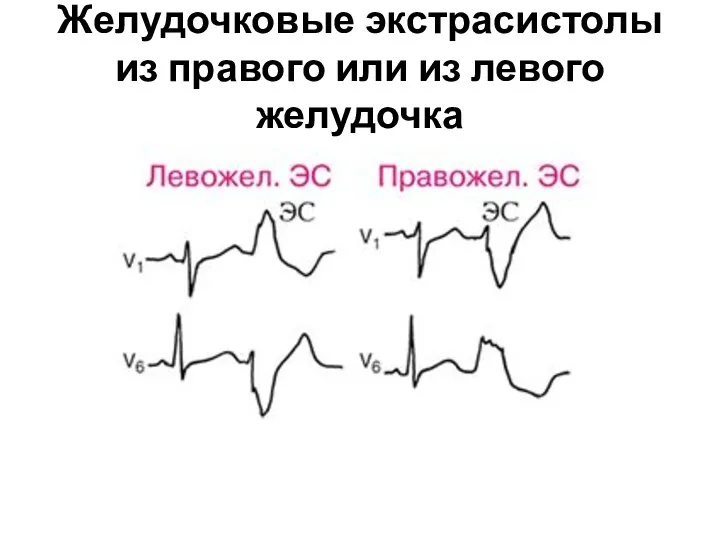 Желудочковые экстрасистолы из правого или из левого желудочка