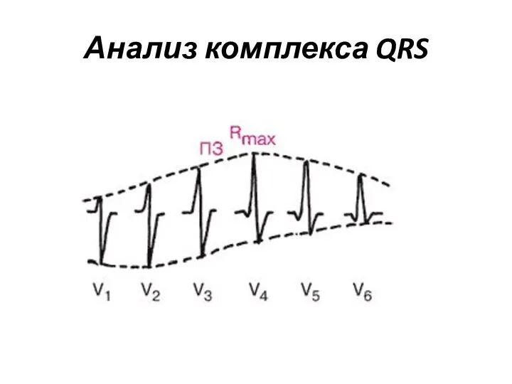 Анализ комплекса QRS