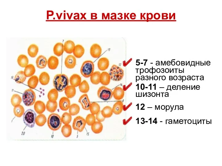 P.vivax в мазке крови 5-7 - амебовидные трофозоиты разного возраста