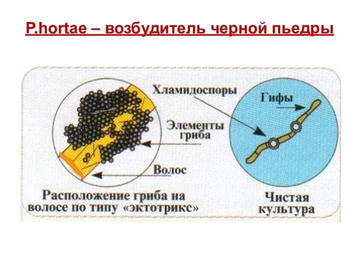 P.hortae – возбудитель черной пьедры