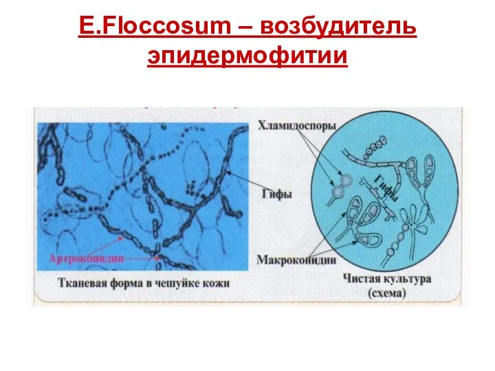 E.Floccosum – возбудитель эпидермофитии