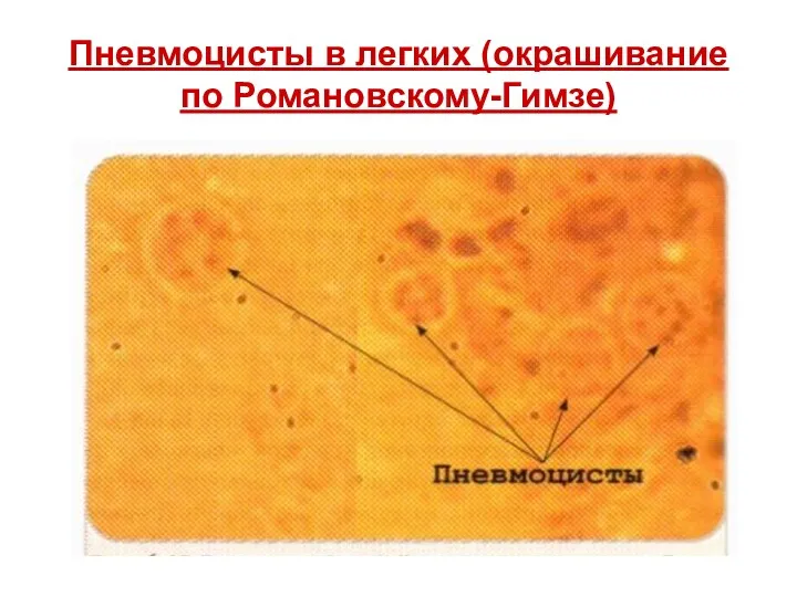 Пневмоцисты в легких (окрашивание по Романовскому-Гимзе)