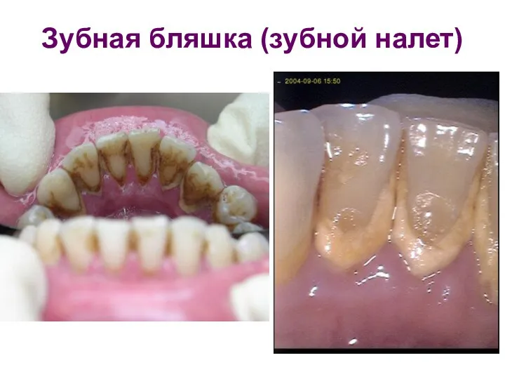 Зубная бляшка (зубной налет)