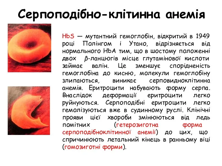 Серпоподібно-клітинна анемія НbS — мутантний гемоглобін, відкритий в 1949 році