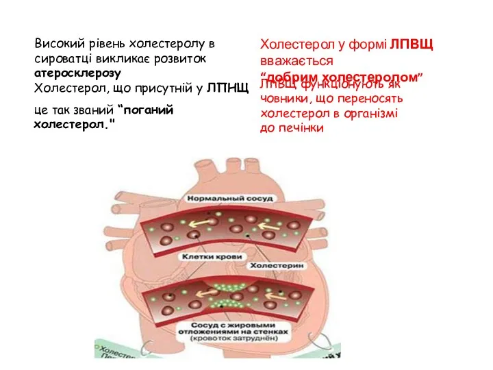 Високий рівень холестеролу в сироватці викликає розвиток атеросклерозу Холестерол, що