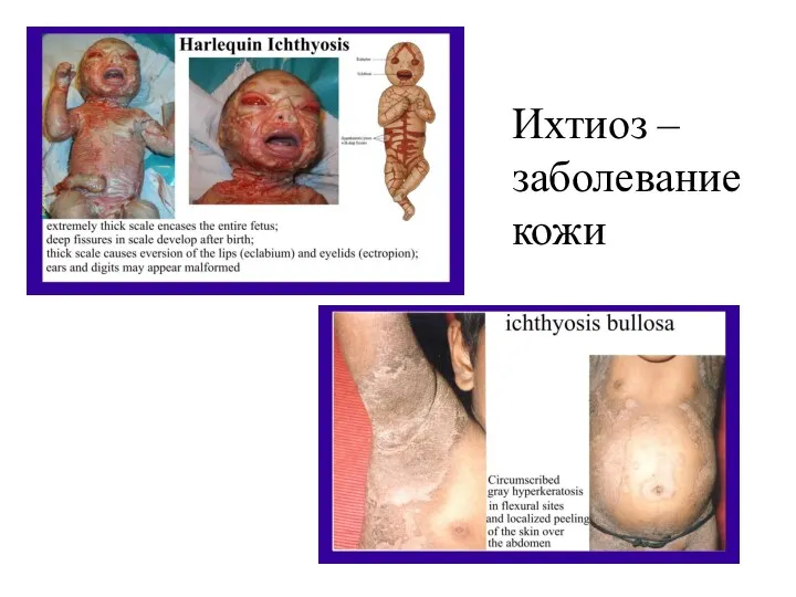 Ихтиоз – заболевание кожи