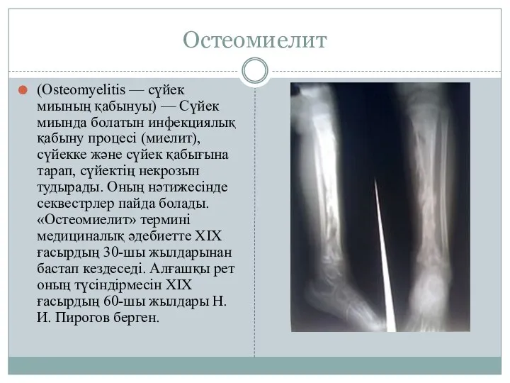 Остеомиелит (Osteomyelitis — сүйек миының қабынуы) — Сүйек миында болатын